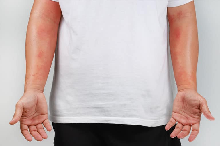 movile-hemangiomas