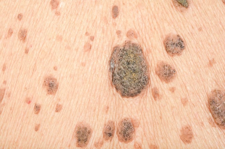 movile-hemangiomas