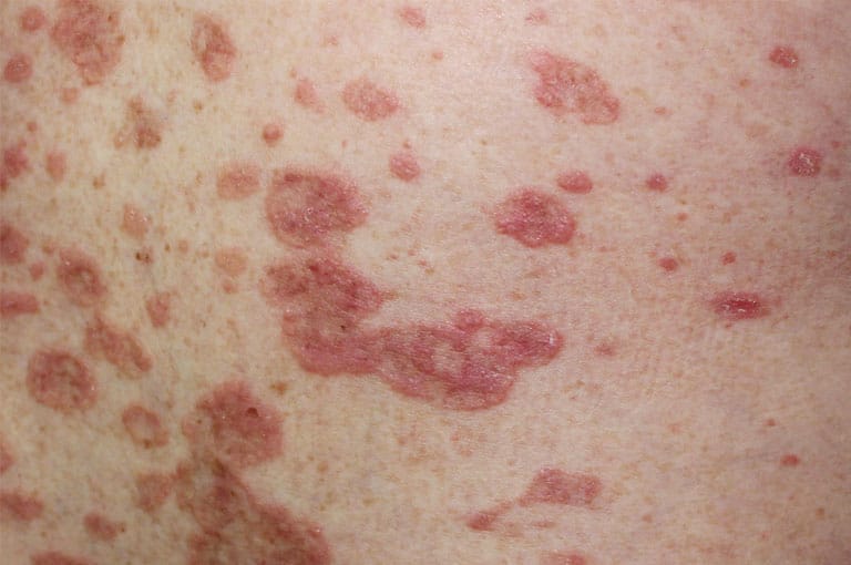 movile-hemangiomas