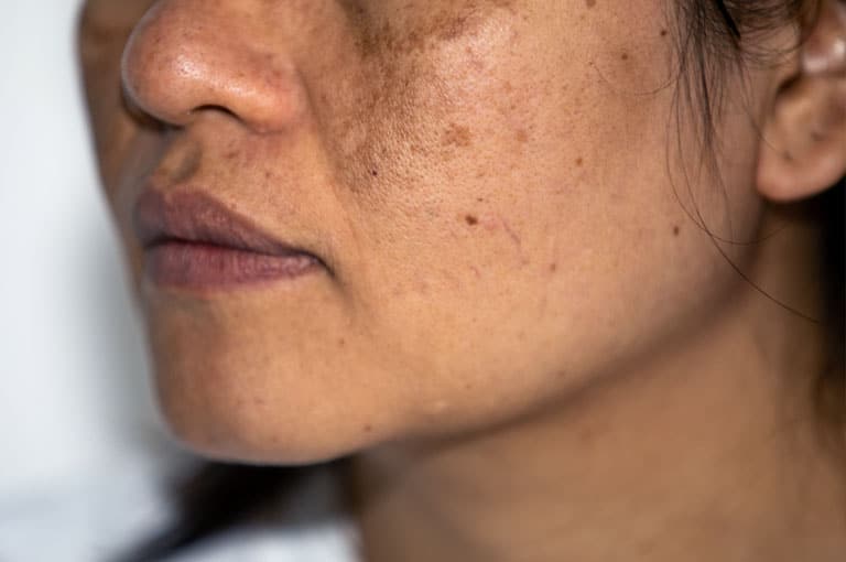 movile-hemangiomas