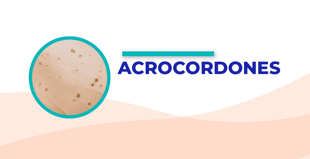 Conoce cómo quitar los acrocordones con láser.