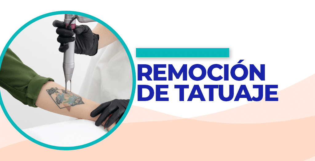 ¿Se pueden eliminar los tatuajes?