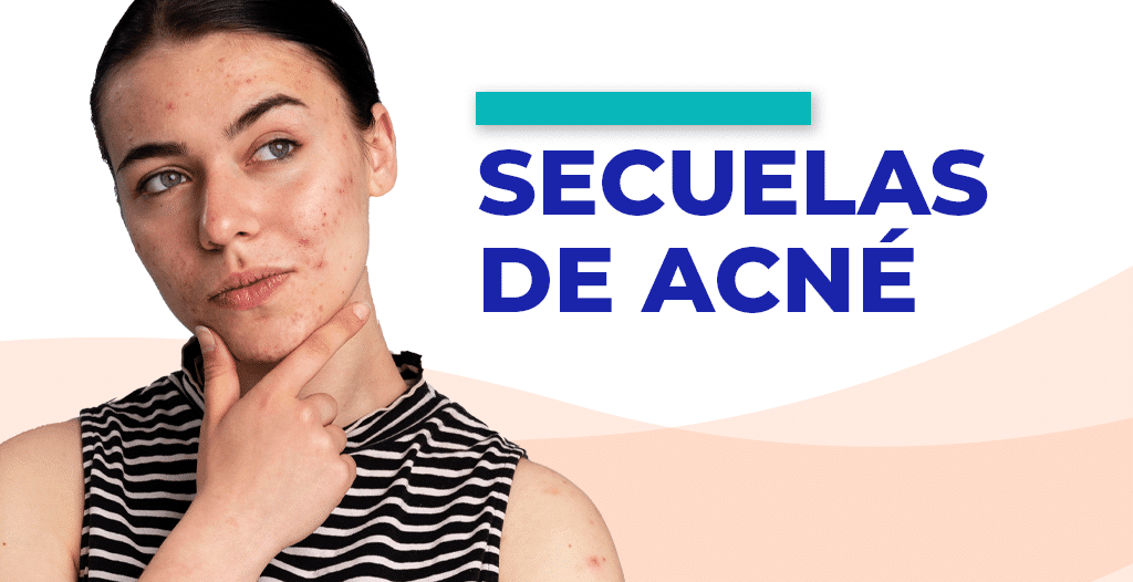 Elimina las secuelas del acné con láser.