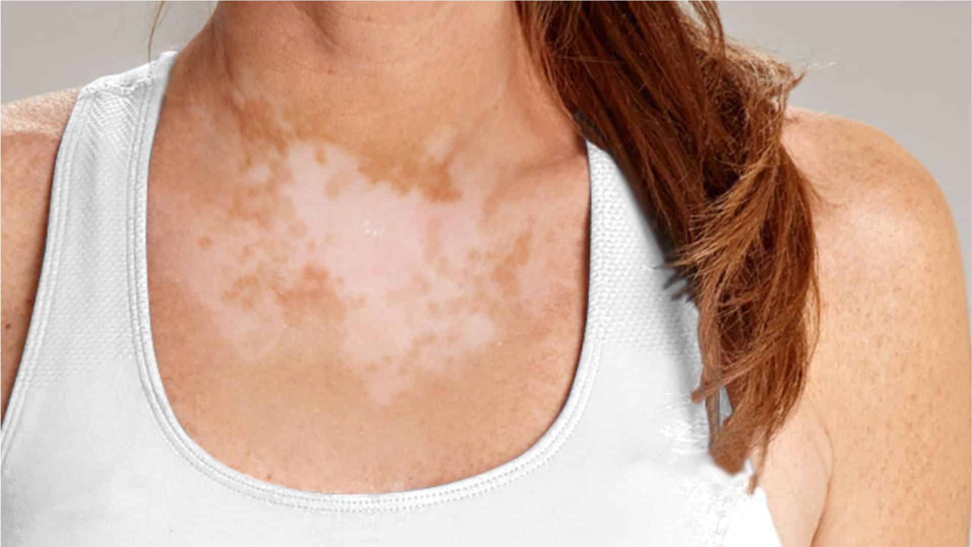 ¿Se puede tratar el vitiligo con láser?